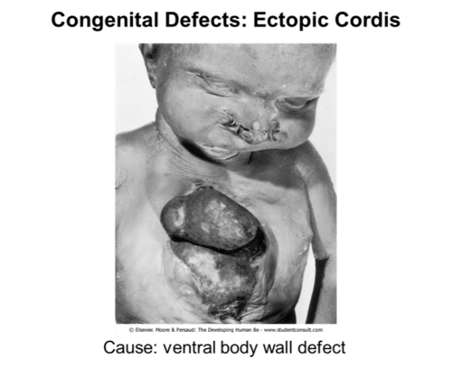 <p>ectopic chordis (heart on exterior)</p>