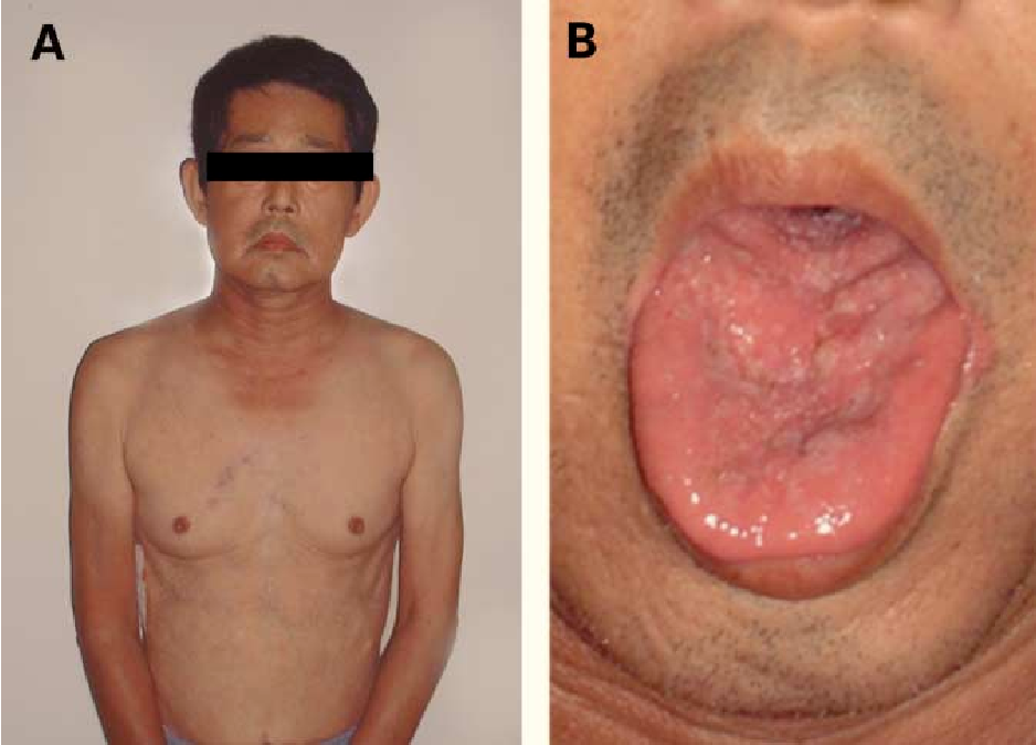 <ul><li><p><strong>progressive neuromuscular degenerations of lower motor neurons</strong></p></li><li><p>muscle weakness, atrophy, fasciculations of bulbar and limbs </p></li><li><p>gynecomastia</p></li><li><p>testicular atrophy</p></li><li><p>reduced fertility</p></li></ul>