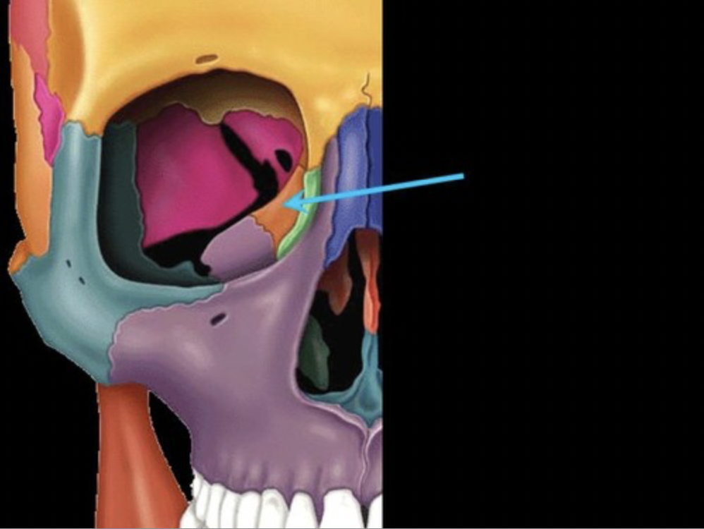 <p>forms part of the posterior portion of the nose, the orbit, and the floor of the cranium</p>