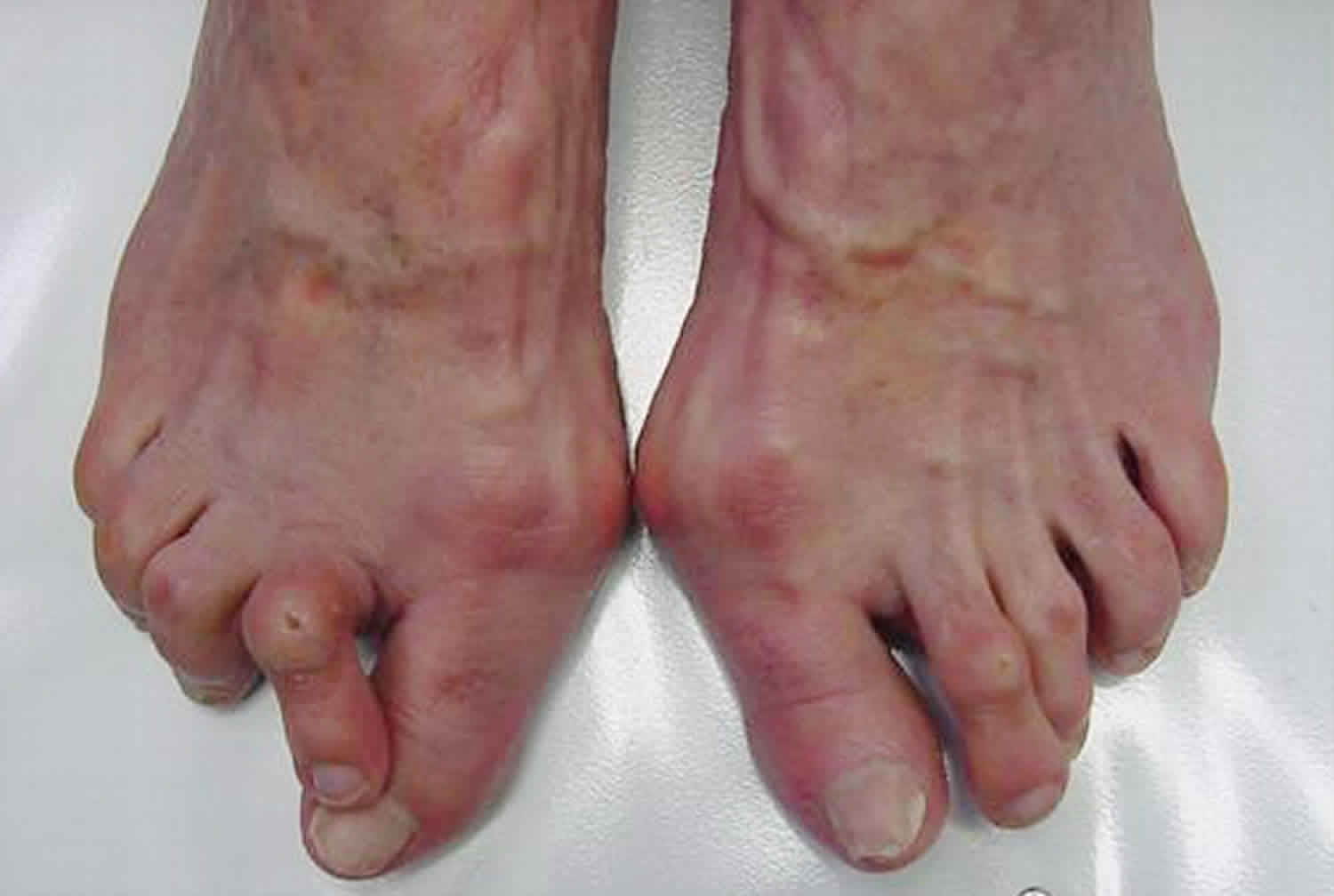 <p>Gishti i madh i shputes shkon nga ana e jashtme dhe kalon mbi gishtin e dyte (hallux valgus)</p>