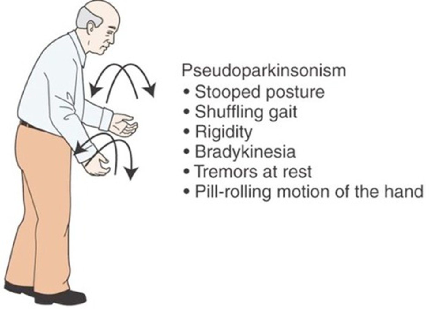 <p>Parkinson's disease-like extrapyramidal symptoms that are adverse effects associated with particular drugs or brain injuries</p>