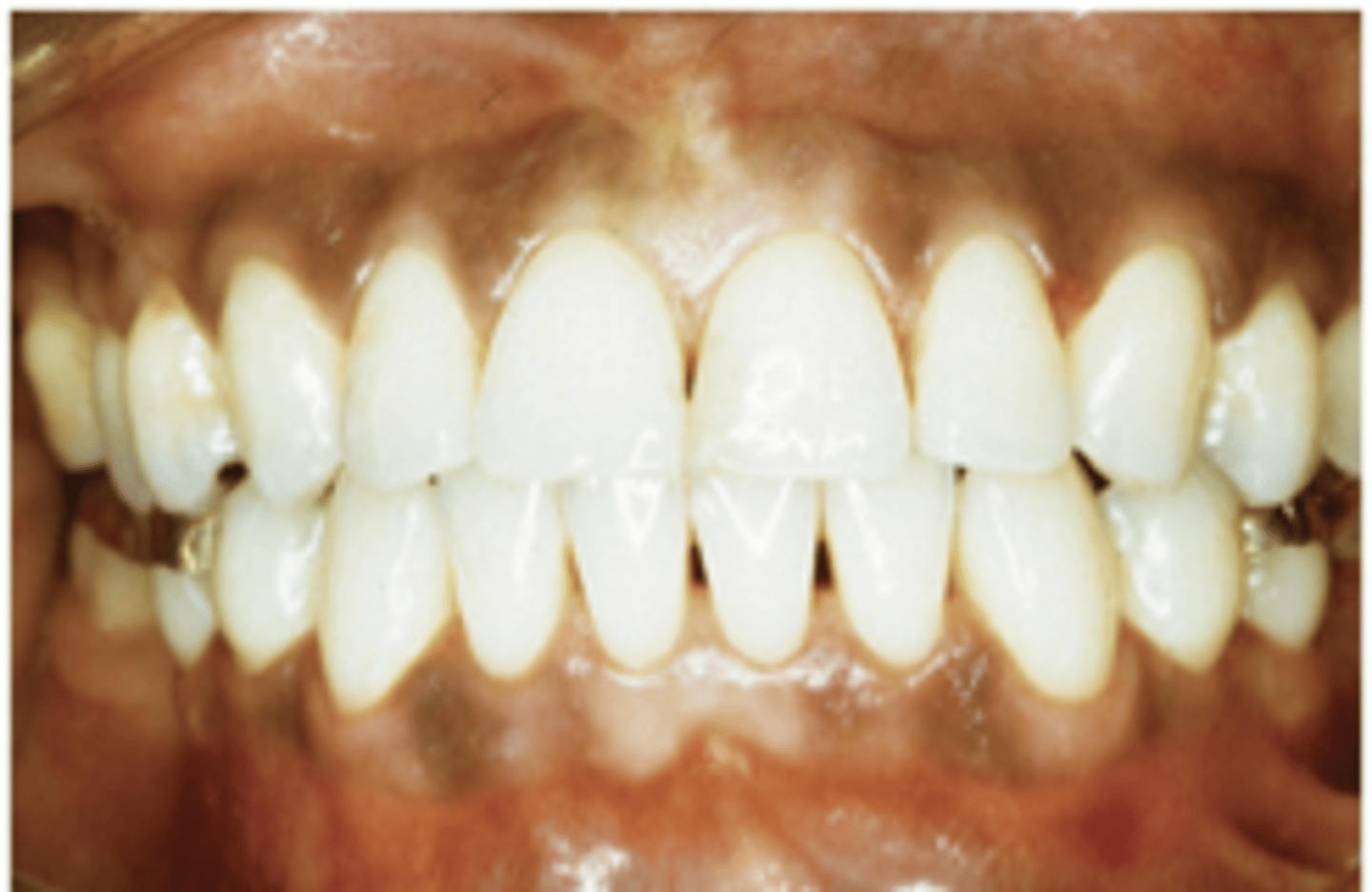<p>1. increased production of melanin from melanocytes</p><p>2. health issues</p>