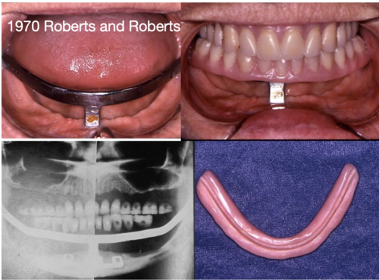 <p>What type of implant?</p>