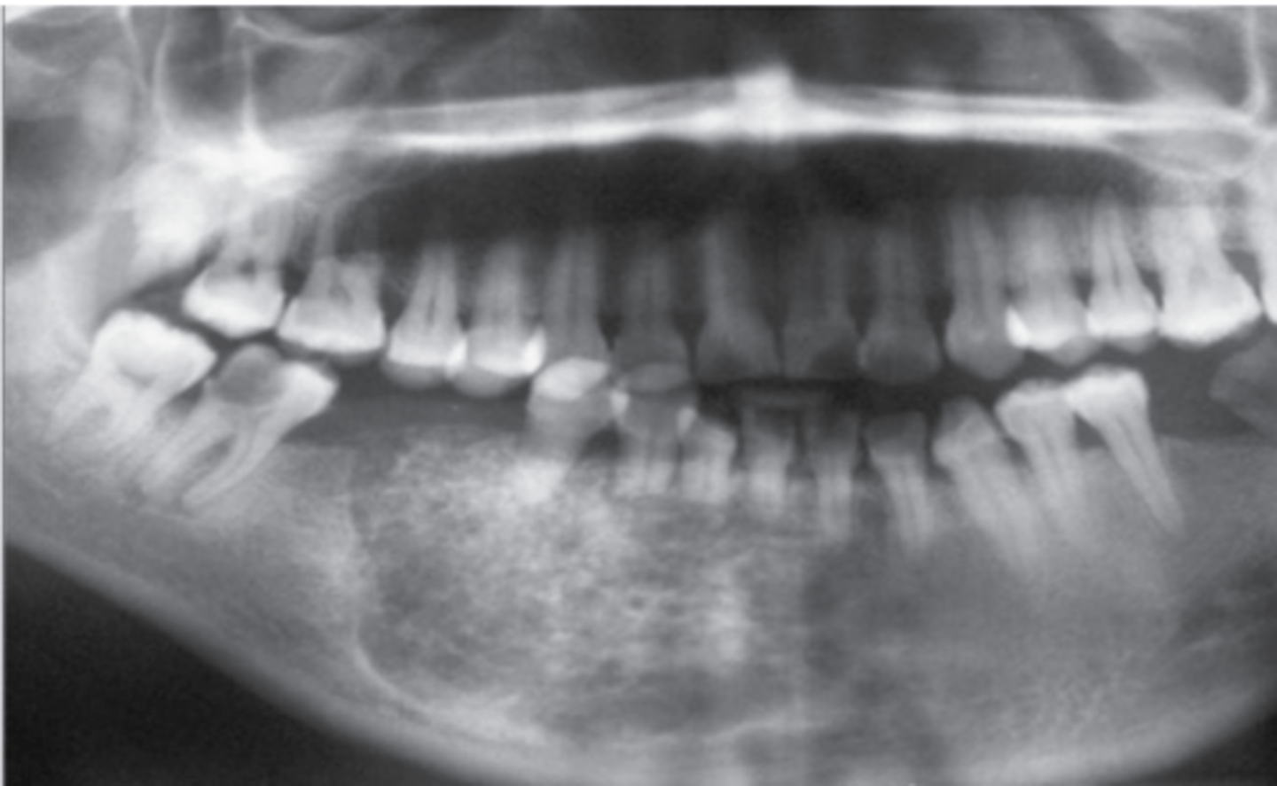 <p>asymptomatic and slow growing</p><p>xray- mixed radiolucent/ radiopaque</p>