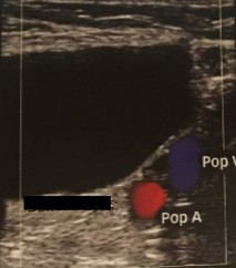 <p>The sonographer is scanning behind the knee during a venous exam and stumbles upon this anechoic finding. </p><p>What can be assumed here? </p>
