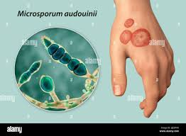 <p>Which Micosporum species causes an epidemic form of tinea capitis in children?</p>