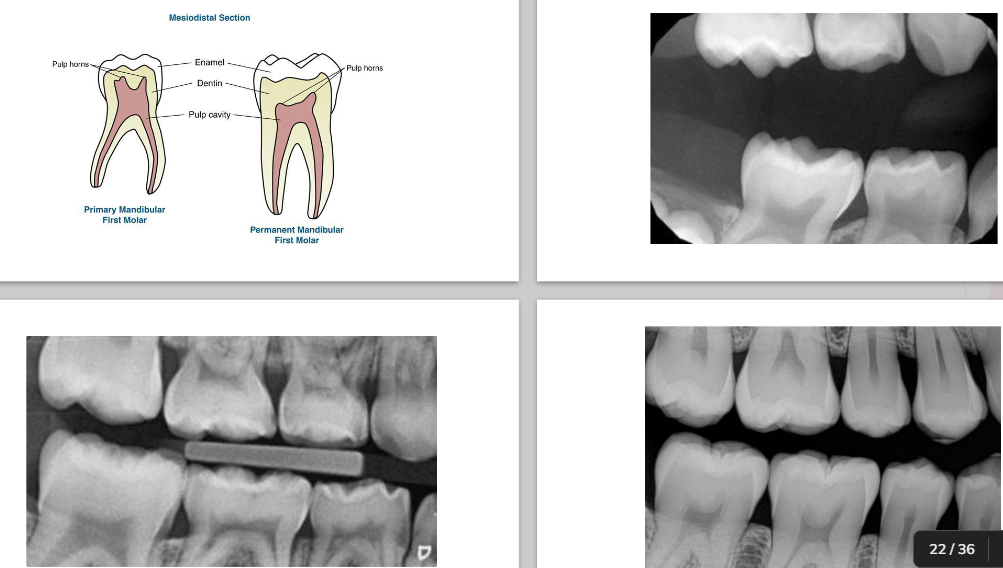 <p><span><strong> Enamel and dentin are thinner in primary </strong></span></p><p><span><strong> Pulp chamber is wider </strong></span></p><p><span><strong> Pulp horn is more prominent </strong></span></p><p><span><strong> Smaller root trunk for primary</strong></span></p>