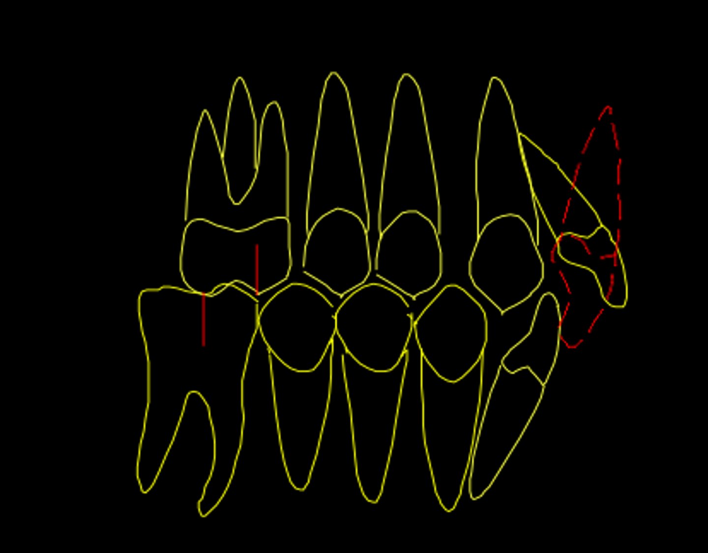 <p>ID the class of occlusion:</p>