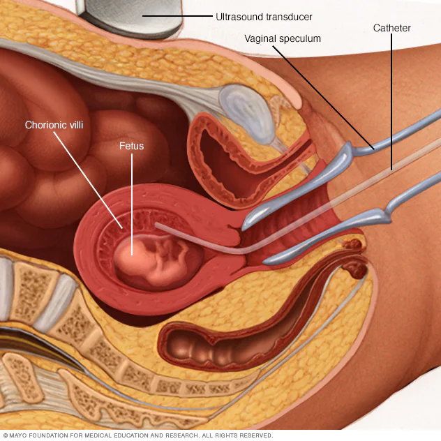 <p>Chorionic villus sampling (CVS), or chorionic villus biopsy, is a prenatal test that involves taking a sample of tissue from the placenta to test for chromosomal abnormalities and certain other genetic problems.</p>