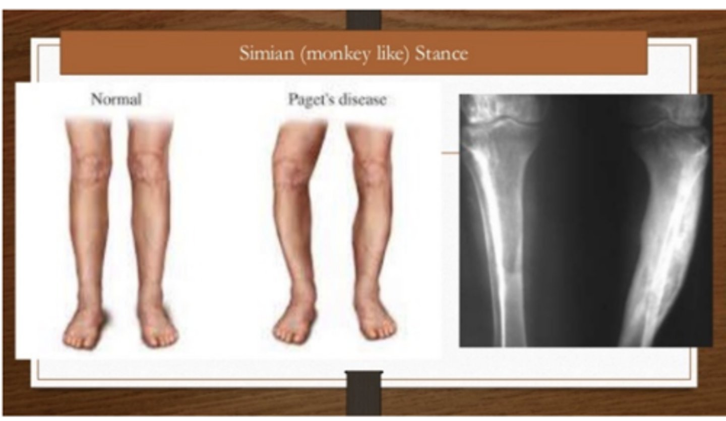 <p>What are some clinical manifestations of Paget disease of bone</p>