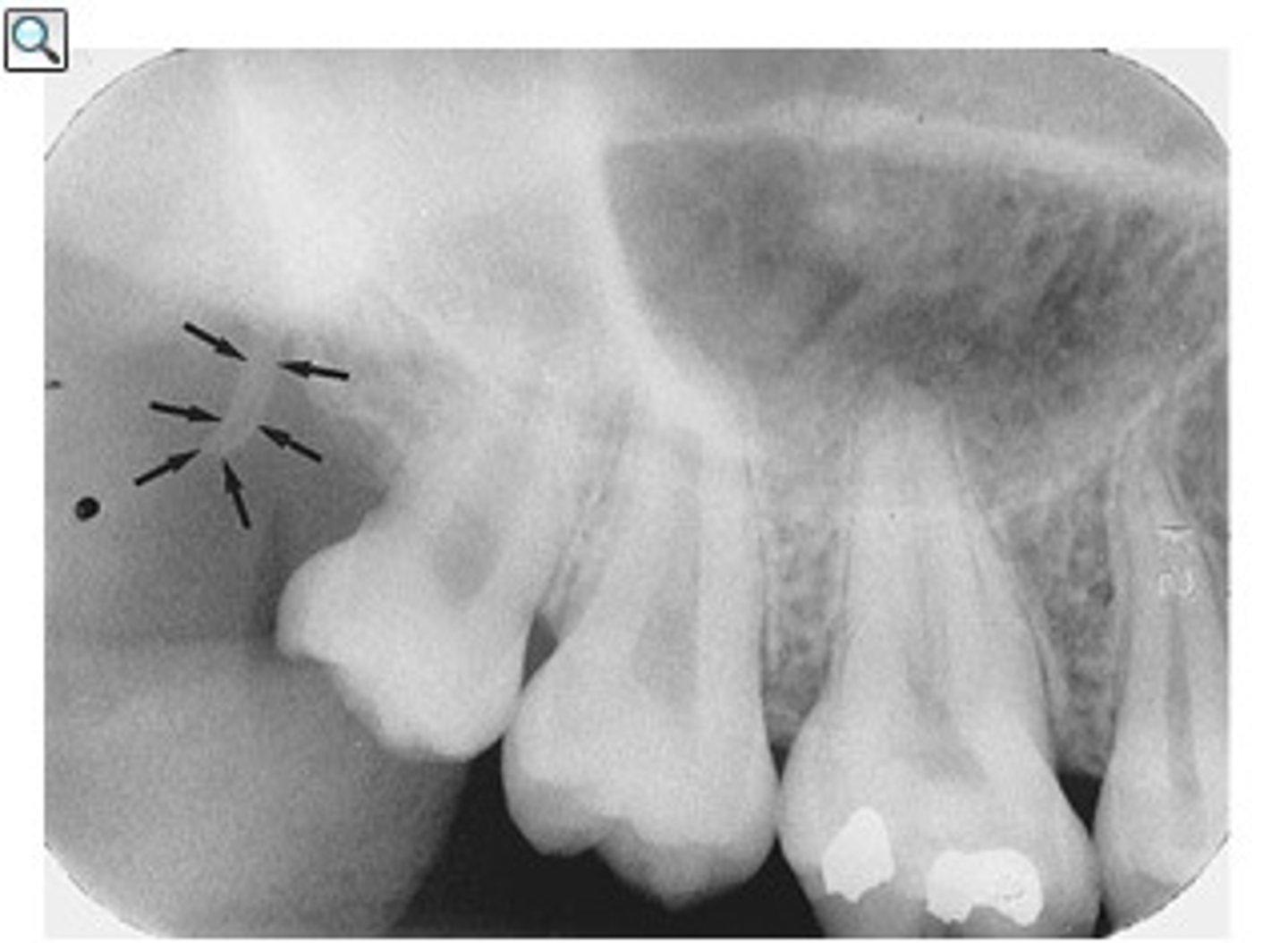 <p>spike of bone seen behind the last molar</p><p>radiopaque</p>