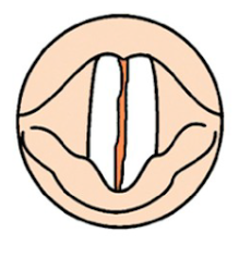 What type of VF closure is this?