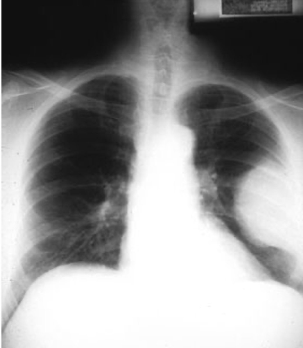 <p>Dx. What is the most common cause of this finding?</p>
