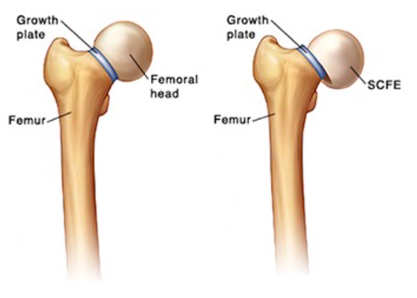 <p>SCFE is a proximal femoral physis condition that involves slippage of the metaphysis relative to the epiphysis</p>