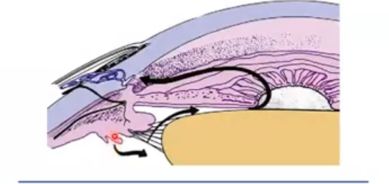 <p>flow of aqueous humour </p>
