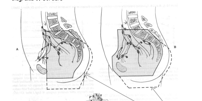 <ul><li><p>Anterior: symphysis pubis; ensuring tx of external iliac nodes</p></li><li><p>Posterior: 1.5-2.0 cm behind the anterior bony sacral margin</p></li></ul><p></p>