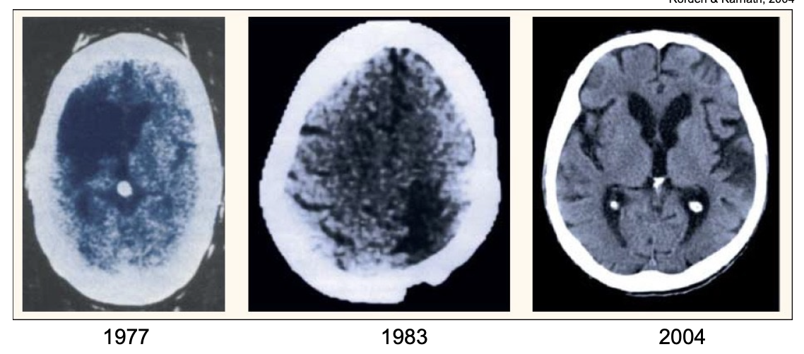 <p>computerized axial tomography scan, noninvasive imaging using X-rays creating detailed pictures of inside of the body</p><ul><li><p>type of X-ray</p></li><li><p>scanner takes multiple images of the brain from different angles, which are then set to a computer - analyzes radiation absorption patterns</p></li><li><p>used for: assessing for brain tumours/other lesions, detect clots in the brain, guide biopsies of brain tissue</p></li><li><p>can’t easily resolve white vs. grey matter, easy to implement but not useful for research</p></li></ul><p></p>