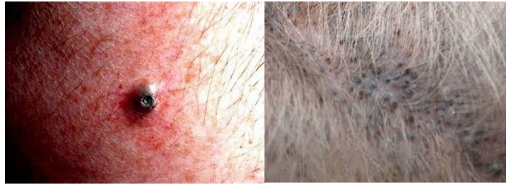 <p>dilated hair follicle filled with cornified cells and sebaceous material</p>