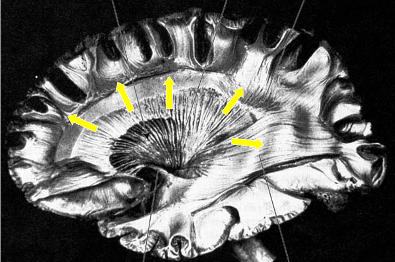 <p>radiating crown of axons travelling from internal capsule to different areas of the cerebral cortex (seen with yellow arrows here)</p>