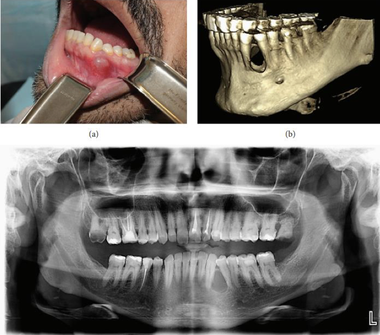 <p>A 43-year-old male patient with a complaint of painless swelling in the left mandibular premolar region. Although the history revealed a presence of the swelling for more than one year without any associated symptoms, the patient preferred to obtain clinical consultation as he was concerned about the swelling. The patient had no previous history of dental treatment except for periodic oral prophylaxis. Provide two differential diagnosis</p>