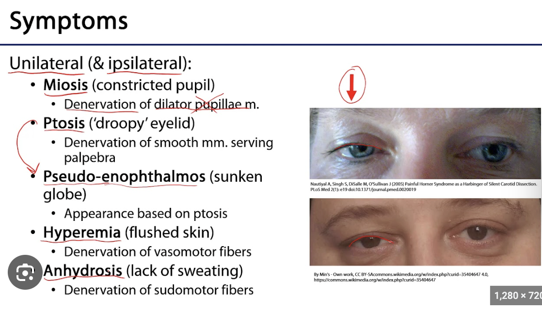 <p>- Ptosis (from Muller's muscle, small, 2-3mm)</p><p>- Miosis</p><p>- Anhidrosis</p><p></p><p>--> Lack of sympathetic nervous system innervation</p>