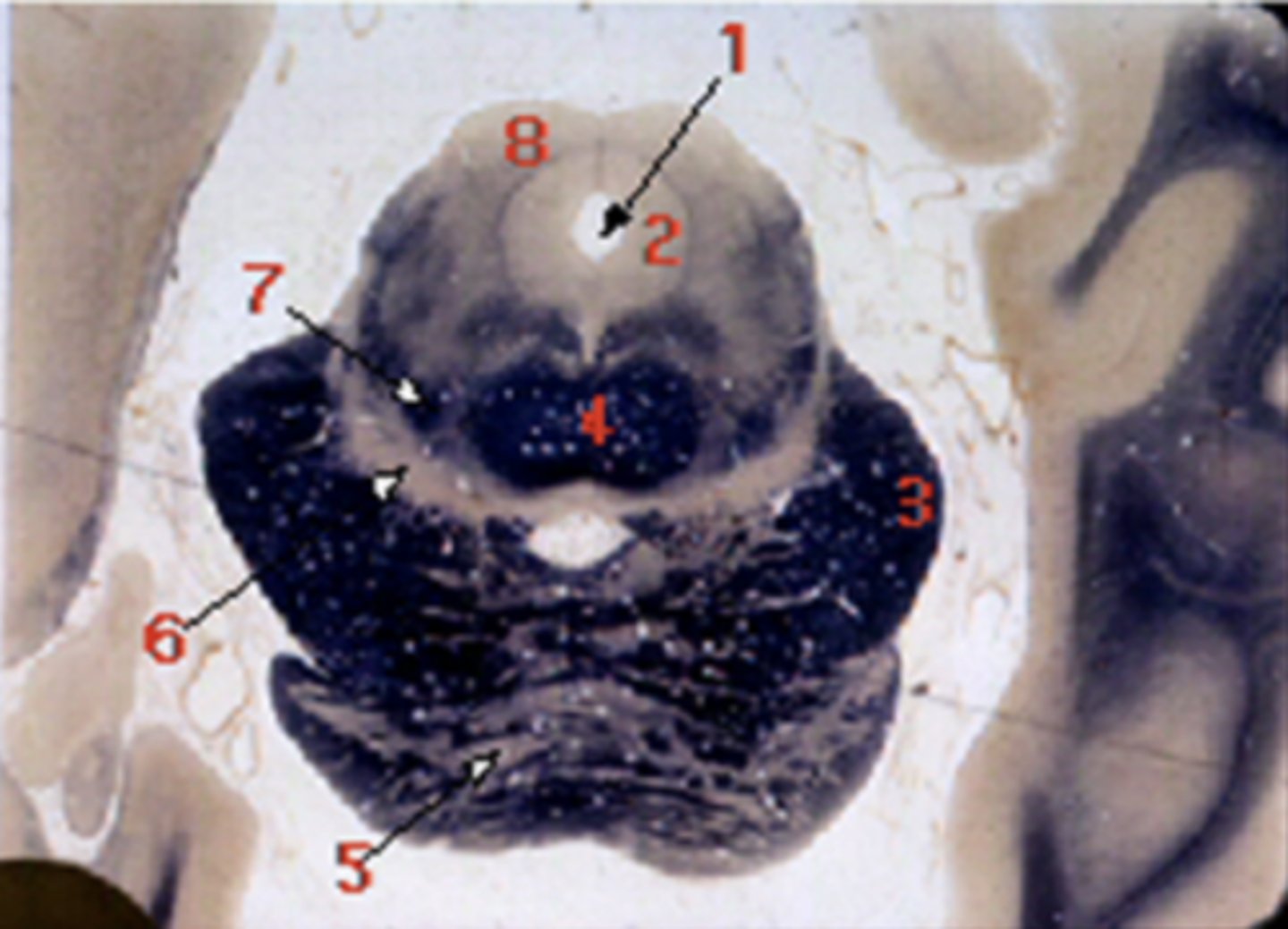 <p>decussation of superior cerebellar peduncle</p>