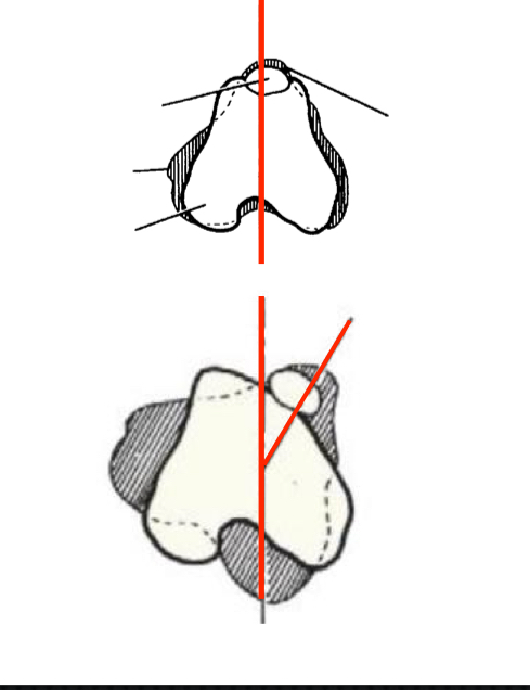 <ul><li><p>Luxation occurs intermittently </p></li><li><p>On palpation, patella luxates easily but still wants to stay in groove</p></li><li><p>In more than out </p></li><li><p><strong>Surgery indicated if CS or are progressive</strong></p></li></ul><p></p>