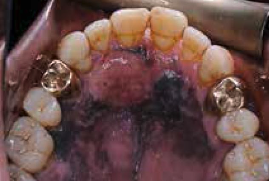 <p>What does ABCDE stand for in Melanoma?</p>