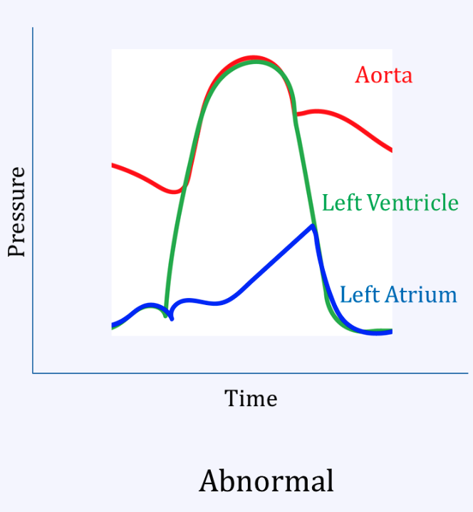 <p>Mitral regurg</p>