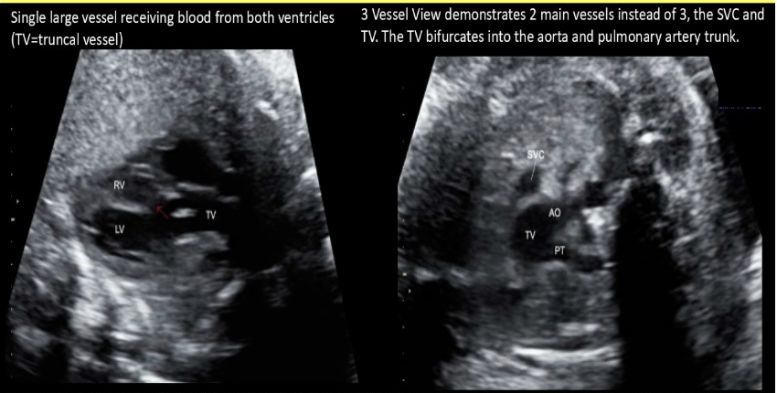<p>you’re scanning a 28w fetal heart. a single large trunk vessel exits the heart + pulmonary artery appears to branch from it instead of from the right ventricle</p><p>a) truncus arteriosus</p><p>b) total anomalous pulmonary venous return</p><p>c) partial anomalous pulmonary venous return </p><p>d) double outlet left ventricle</p>