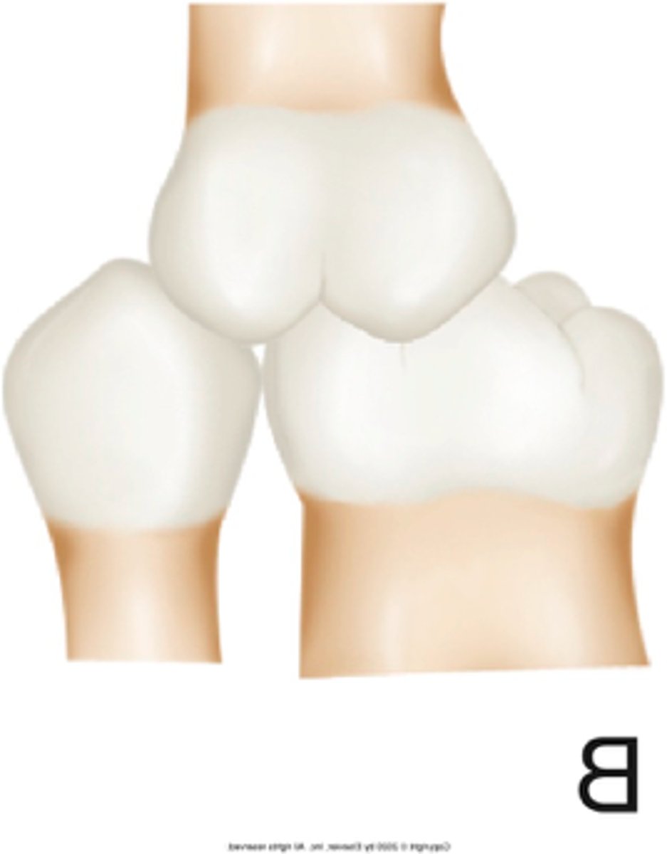 <p>ID the occlusion classification:</p>