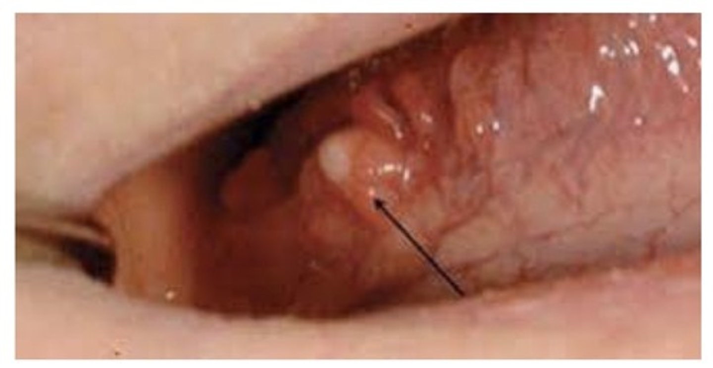 <p>Most commonly found in major salivary glands. Epithelial lining surrounded by a well circumscribed component of lymphoid tissue. Appears to arise from epithelium trapped in a lymph node during development. Most commonly found intraorally on the FOM and lateral boarders of the tongue. Appears as a pinkish-yellow raised nodule. Tx: surgical excision.</p>