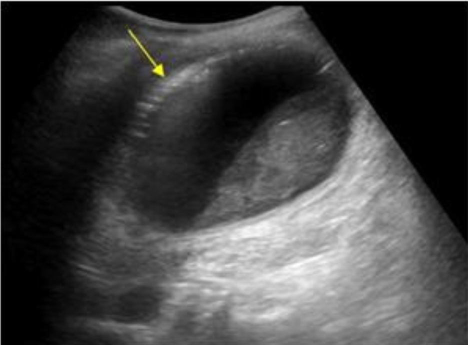 <p>I<span>nfection with gas-forming bacteria; elderly diabetics; surgical emergency </span></p><p><span>Gas in GB wall/lumen as echogenic foci with dirty shadowing or ring-down artifact; air-fluid levels </span></p>