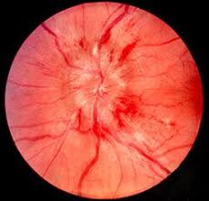 <p>PP: increased intracranial pressure→optic nerve edema</p><p>E: intracranial mass<br>intracranial hemorrhage<br>meningitis</p><p>CM: swollen optic disc<br>blurred margins</p>