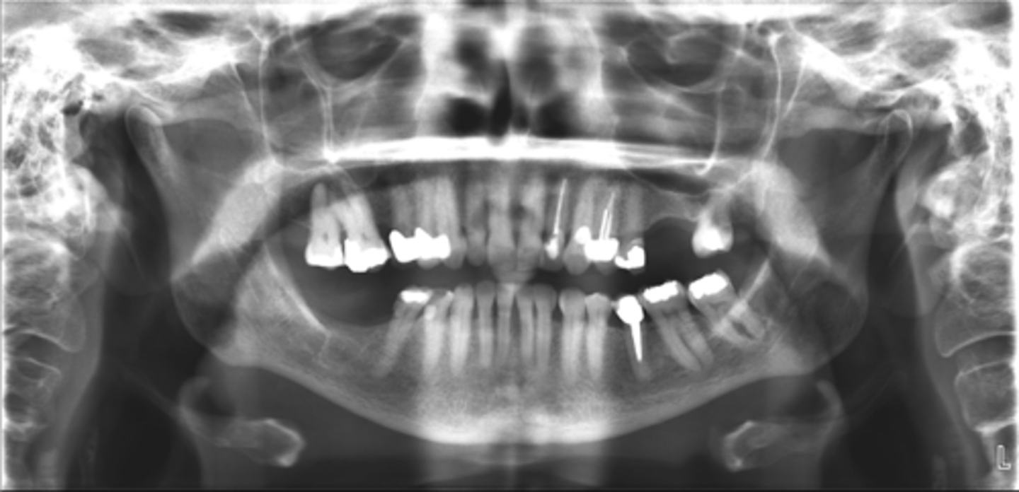 <p>ID the calcified abnormality:</p>