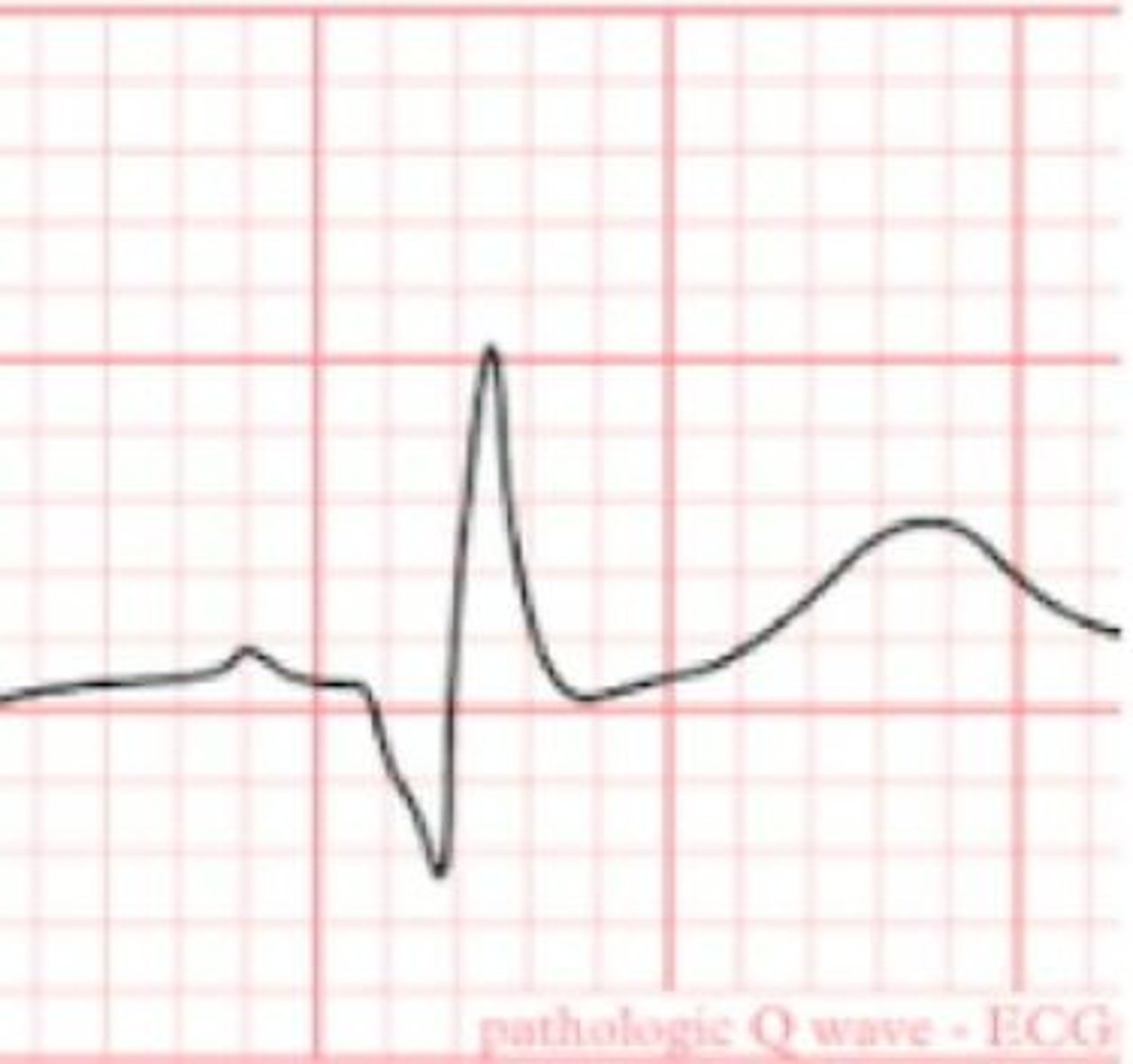 <p>It indicates myocardial infarction if it lasts 0.03 seconds or longer and has a vertical deflection of at least 1/3 of the R wave.</p>
