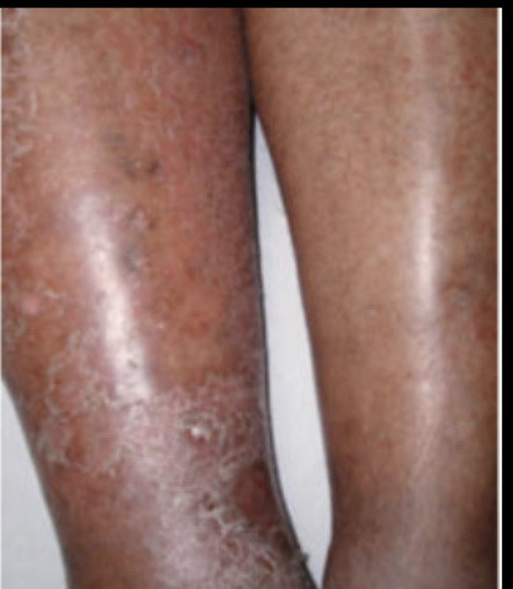 <p>Stasis Dermatitis</p>