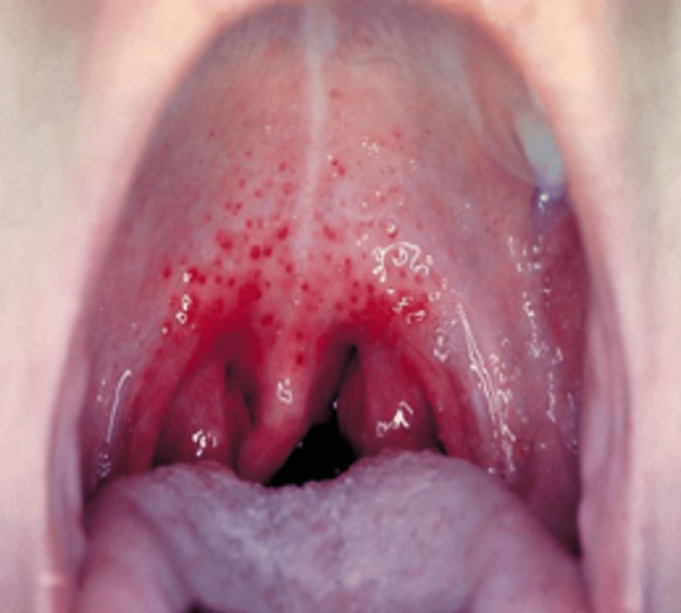 <p>-<em>S. pyogenes </em>is major cause of pharyngitis</p><p>-Intense pharyngeal redness/edema, tonsillar exudate, and cervical lymphadenopathy</p>
