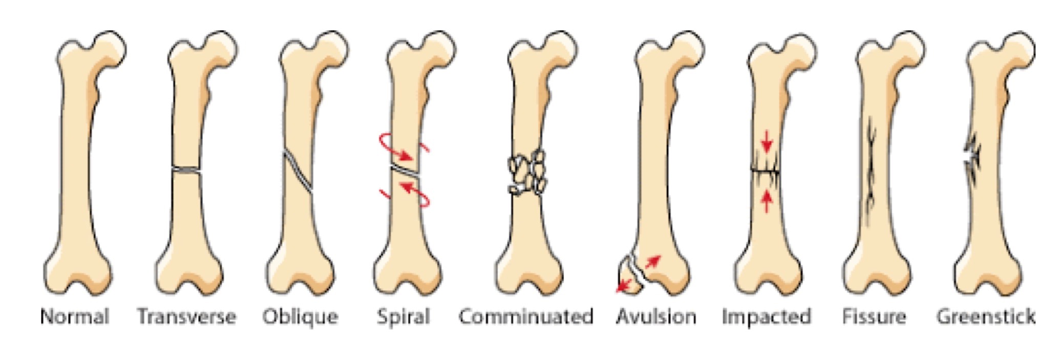 list the patterns and comminution of the following fractures: