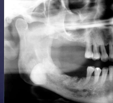 <ol><li><p>internal structure- uniformly radiopaque or internal trabecular structure</p></li><li><p>maybe be exophytic (projects outward), extending into adjacent soft tissues</p></li></ol><p></p>