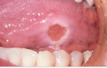<p>what is the treatment for this? </p>