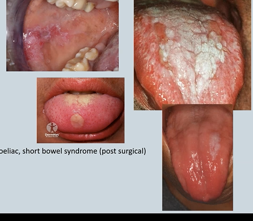 <ol><li><p>keratosis – White patches</p><ul><li><p>Lichen planus</p></li><li><p>Lupus</p></li><li><p>Immunosuppression</p></li><li><p>Candidosis</p></li><li><p>Syphilis</p></li><li><p>hyperkeratosis - take a biopsy to make sure its not cancer </p></li></ul></li><li><p>Glossitis →Anaemia or Vitamin deficiencies (need to regenerate the surface of your mouth)→ <em>B12 – pernicious anaemia→ Malabsorption syndromes – coeliac, short bowel syndrome (post surgical)</em></p></li></ol><p></p>