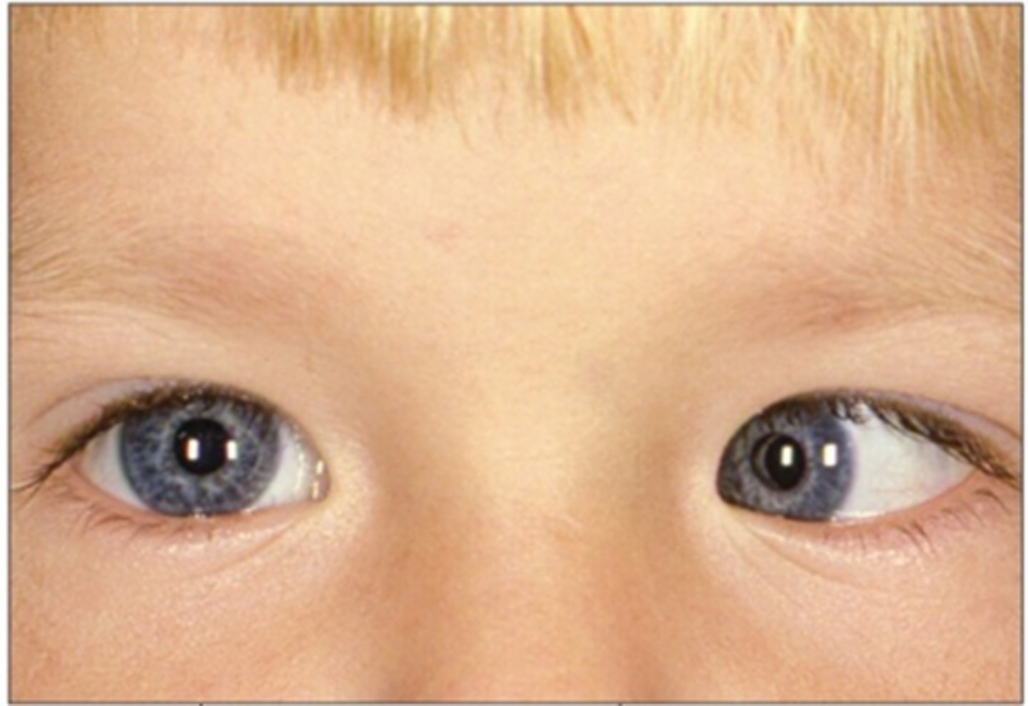 <p>0.5% ung BID for 1 day before exam</p><p>mostly age 1-6</p>