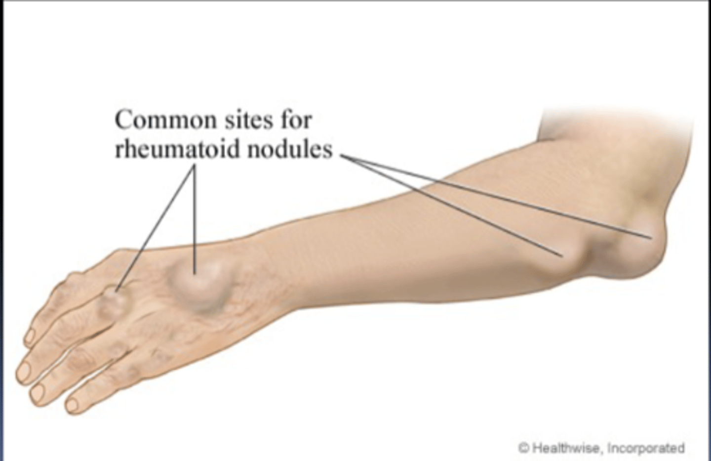 <p>granulomatous and fibrous soft tissue masses found on bony prominences exposed to pressure but can occur in other areas</p><p>be sure to note:</p><p>-location</p><p>-size</p><p>-sensitivity</p><p>-number</p><p>-consistency</p>