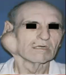 <p>What is another name for Pleomorphic Adenoma?</p>