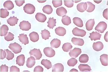 <p><span>A 65-year-old male presents to a primary care clinic for his first checkup in 25 years. He complains of nausea, vomiting, and anorexia that have been present for the last 6 months. In addition, he reports difficulty sleeping, which he attributes to severe, diffuse itchiness. His medical history is significant for type 2 diabetes mellitus. He does not take any medications currently but admits to being on insulin in the past after he failed treatment with metformin.&nbsp; On examination, the patient has a thin body habitus and flaky skin with excoriations on his bilateral arms and legs. A blood smear is shown in the exhibit. </span></p><p><span>The most likely additional finding is</span></p>