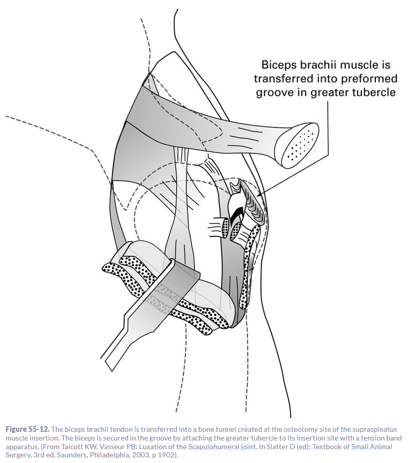 <p>A deep groove is made in greater tubercle for biceps tendon → cut tendon → move tendon → tubercle replaced over tendon secured w/ screw or pin/tension band</p>