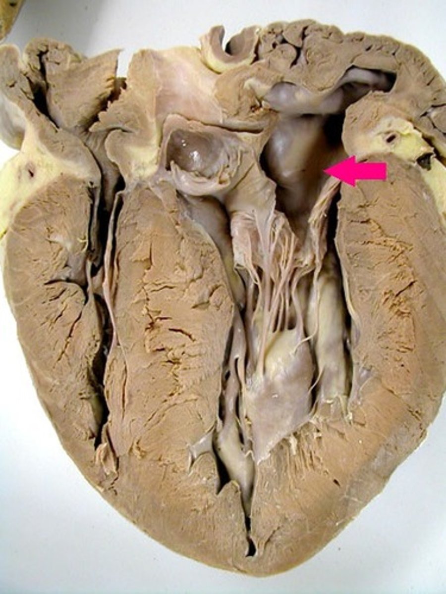 <p>Identify the chamber.</p><p>Thin-walled chamber of the heart. Above left ventricle. Includes left auricle.</p>