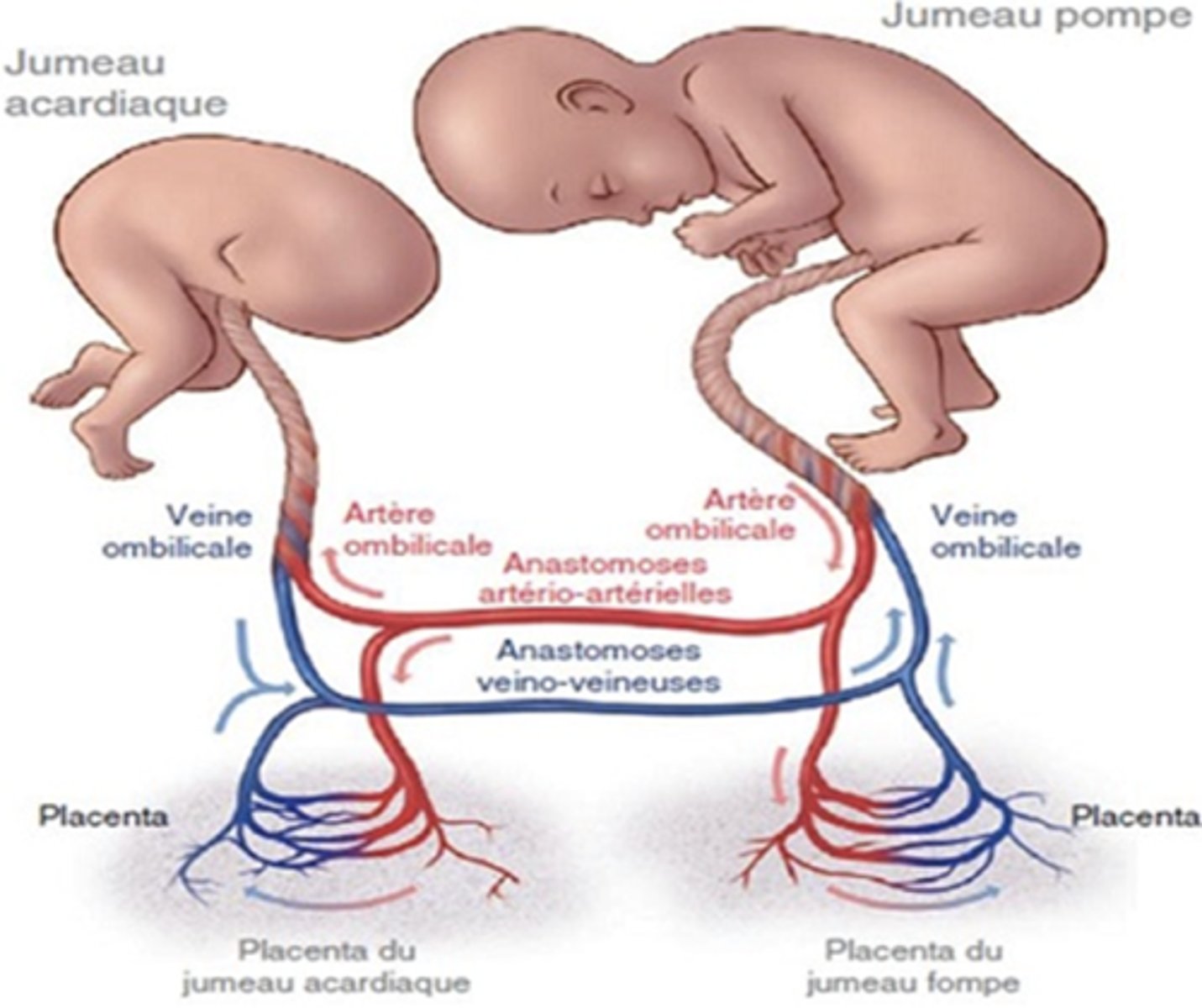 <p>No heart</p><p>Absent upper body</p><p>Reversal of flow in umbilical artery</p>
