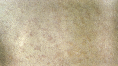 <p>A pink rash lasting 3 days, starting on the face and spreading downward.</p>